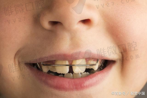 牙齿漂白和洗牙有什么区别（冷光漂白牙齿）